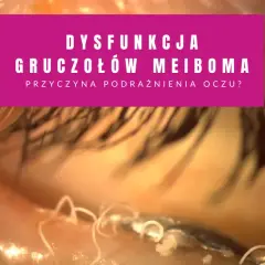 Widok oka z dysfunkcją gruczołów Meiboma. Widoczne są białe, nitkowate struktury, które mogą być objawami zatkanych gruczołów.