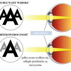 Oko bez wady wzroku ostro widzi litery "A". Krótkowzroczność powoduje, że obraz jest nieostry, a gałka oczna wydłuża się. Skurcz akomodacyjny może pogłębiać wadę.