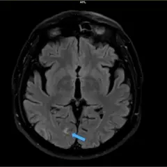 Zmiana w mózgu, wskazana strzałką, może być przyczyną mózgowych zaburzeń widzenia.