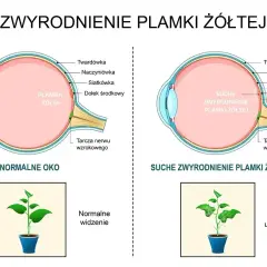 Schemat porównuje zdrowe oko z suchym zwyrodnieniem plamki żółtej, pokazując wpływ na widzenie. Leczenie zachowawcze błony nasiatkówkowej jest kluczowe.