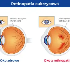 Porównanie zdrowego oka z naczyniami krwionośnymi siatkówki i oka z retinopatią, gdzie widoczne są mikrowylewy.
