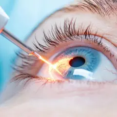 Laserowa irydotomia. Zabieg na oku, po którym należy przestrzegać zaleceń. Widoczny promień lasera działający na tęczówkę.