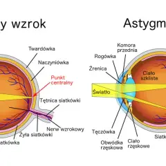 Porównanie budowy oka z normalnym wzrokiem i astygmatyzmem, gdzie wada wzroku plus i minus jednocześnie powoduje zniekształcenie obrazu.