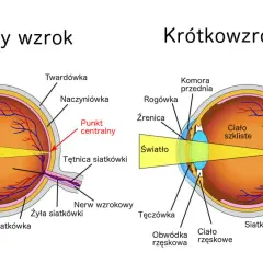 Porównanie budowy oka: normalny wzrok vs. wada wzroku - krótkowzroczność. Pokazano, jak światło skupia się na siatkówce.