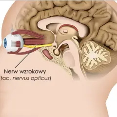 Schematyczny przekrój głowy ukazujący oko i nerw wzrokowy. Uszkodzony nerw wzrokowy może wymagać operacji.