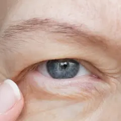 Opadająca powieka może być objawem problemów neurologicznych. Widoczne zmarszczki wokół oka.
