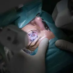 Oko pacjenta podczas zabiegu witrektomii. Chirurg w rękawiczkach precyzyjnie operuje, widoczna jest soczewka oka.
