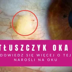 Żółta plamka na oku, czyli tłuszczyk, widoczna na białku. Dowiedz się więcej o tej narośli.