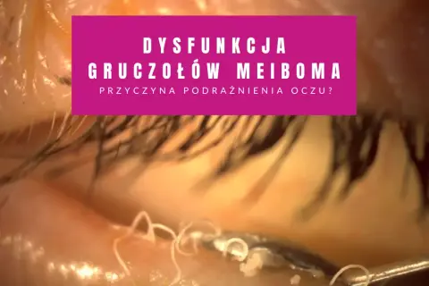 Widok oka z dysfunkcją gruczołów Meiboma. Widoczne są białe, nitkowate struktury, które mogą być objawami zatkanych gruczołów.