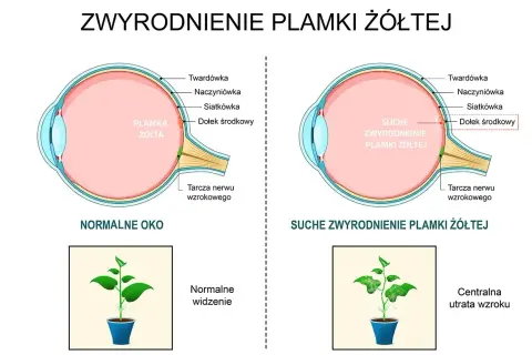 Porównanie normalnego oka z suchym zwyrodnieniem plamki żółtej. Pokazuje, jak szybko powiększa się otwór plamki żółtej, prowadząc do utraty wzroku.