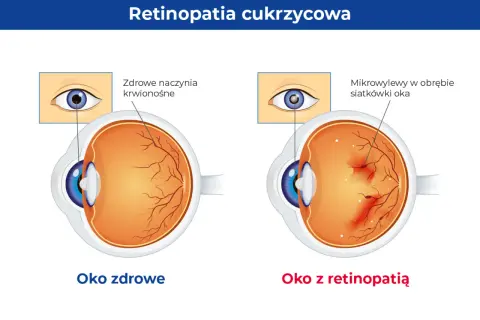 Porównanie zdrowego oka z naczyniami krwionośnymi siatkówki i oka z retinopatią, gdzie widoczne są mikrowylewy.