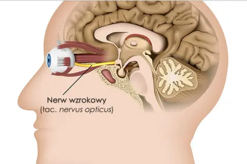Przekrój głowy ukazujący oko i mózg. Widoczny nerw wzrokowy, którego porażenie może prowadzić do utraty wzroku.