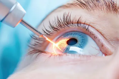 Laserowa irydotomia. Zabieg na oku, po którym należy przestrzegać zaleceń. Widoczny promień lasera działający na tęczówkę.