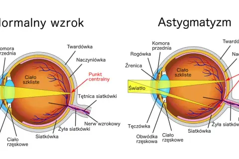Porównanie budowy oka z normalnym wzrokiem i astygmatyzmem, gdzie wada wzroku plus i minus jednocześnie powoduje zniekształcenie obrazu.