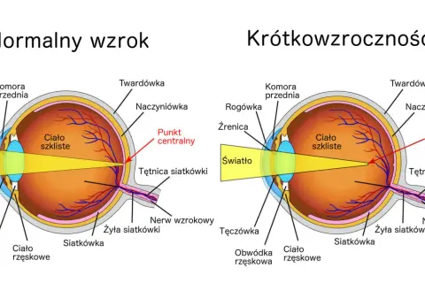 Porównanie budowy oka: normalny wzrok vs. wada wzroku - krótkowzroczność. Pokazano, jak światło skupia się na siatkówce.