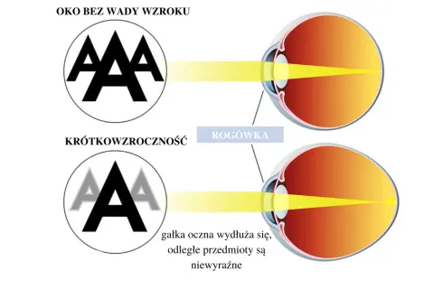 Ilustracja pokazuje przeliczanie wady wzroku na soczewki. Oko bez wady widzi ostro, krótkowzroczne oko widzi niewyraźnie.