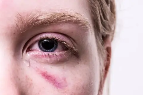 Widoczne uszkodzenie oka z zaczerwienieniem i siniakiem pod nim. Łza spływa po policzku.