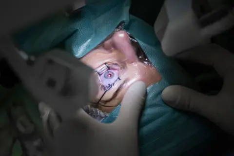 Oko pacjenta podczas zabiegu witrektomii. Chirurg w rękawiczkach precyzyjnie operuje, widoczna jest soczewka oka.