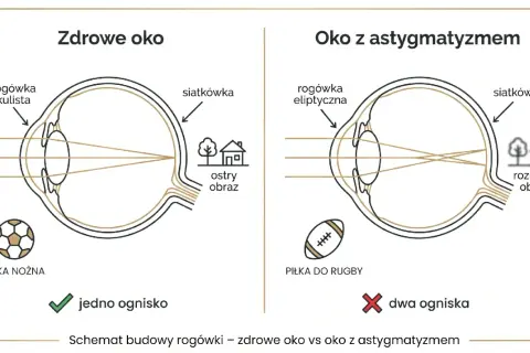 Zdrowe oko z kulistą rogówką skupia światło na siatkówce, dając ostry obraz piłki nożnej. Oko z astygmatyzmem i eliptyczną rogówką tworzy dwa ogniska, rozmywając obraz.