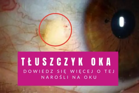 Żółta plamka na oku, czyli tłuszczyk, widoczna na białku. Dowiedz się więcej o tej narośli.