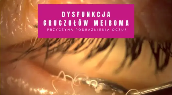 Widok oka z dysfunkcją gruczołów Meiboma. Widoczne są białe, nitkowate struktury, które mogą być objawami zatkanych gruczołów.