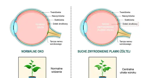 Porównanie normalnego oka z suchym zwyrodnieniem plamki żółtej. Pokazuje, jak szybko powiększa się otwór plamki żółtej, prowadząc do utraty wzroku.