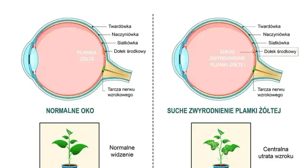 Schemat porównuje zdrowe oko z suchym zwyrodnieniem plamki żółtej, pokazując wpływ na widzenie. Leczenie zachowawcze błony nasiatkówkowej jest kluczowe.