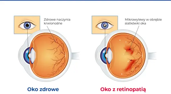 Porównanie zdrowego oka z naczyniami krwionośnymi siatkówki i oka z retinopatią, gdzie widoczne są mikrowylewy.