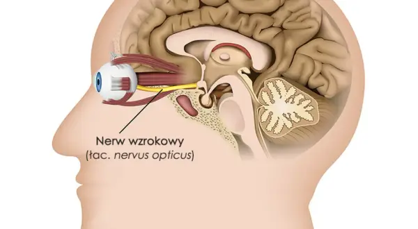 Przekrój głowy ukazujący oko i mózg. Widoczny nerw wzrokowy, którego porażenie może prowadzić do utraty wzroku.