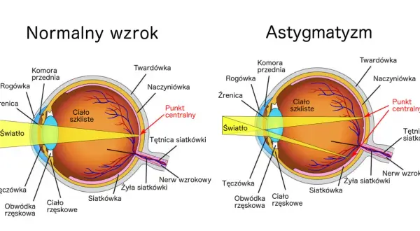 Porównanie budowy oka z normalnym wzrokiem i astygmatyzmem, gdzie wada wzroku plus i minus jednocześnie powoduje zniekształcenie obrazu.