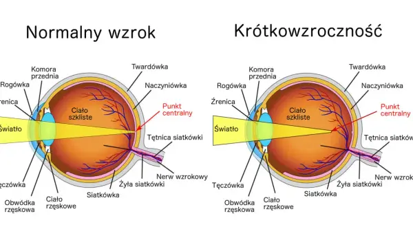 Porównanie budowy oka: normalny wzrok vs. wada wzroku - krótkowzroczność. Pokazano, jak światło skupia się na siatkówce.
