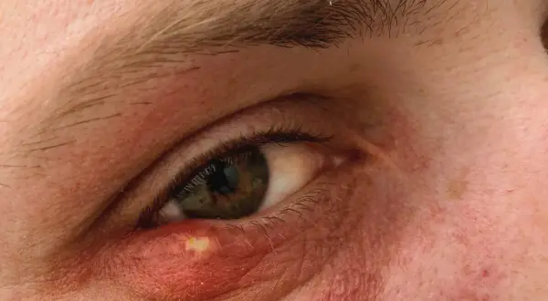 Zapalenie twardówki objawia się zaczerwienieniem i obrzękiem powieki, widoczny jest ropień.