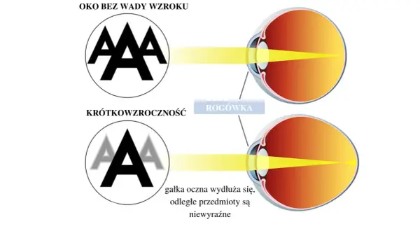 Ilustracja pokazuje przeliczanie wady wzroku na soczewki. Oko bez wady widzi ostro, krótkowzroczne oko widzi niewyraźnie.