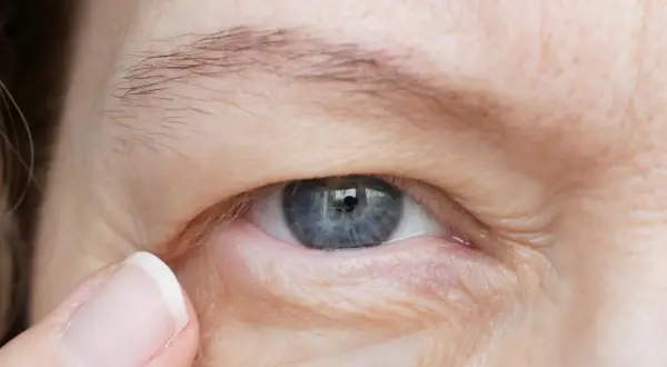 Opadająca powieka może być objawem problemów neurologicznych. Widoczne zmarszczki wokół oka.