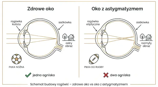 Zdrowe oko z kulistą rogówką skupia światło na siatkówce, dając ostry obraz piłki nożnej. Oko z astygmatyzmem i eliptyczną rogówką tworzy dwa ogniska, rozmywając obraz.