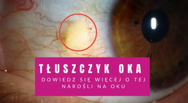 Żółta plamka na oku, czyli tłuszczyk, widoczna na białku. Dowiedz się więcej o tej narośli.