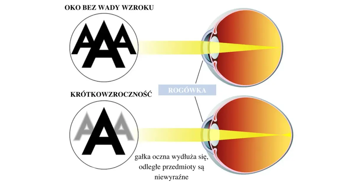 Oko bez wady wzroku ostro widzi litery "A". Krótkowzroczność powoduje, że obraz jest nieostry, a gałka oczna wydłuża się. Skurcz akomodacyjny może pogłębiać wadę.
