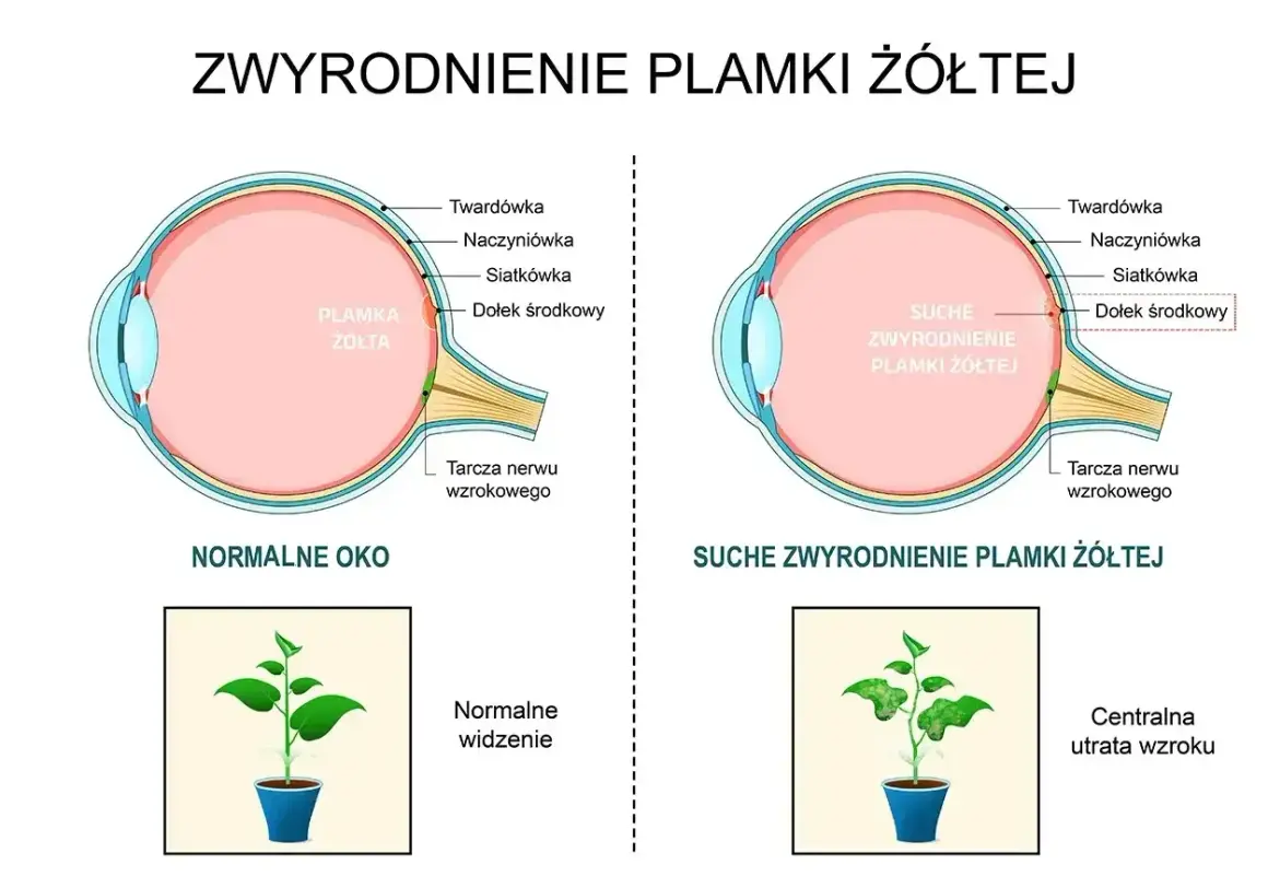 Schemat porównuje zdrowe oko z suchym zwyrodnieniem plamki żółtej, pokazując wpływ na widzenie. Leczenie zachowawcze błony nasiatkówkowej jest kluczowe.
