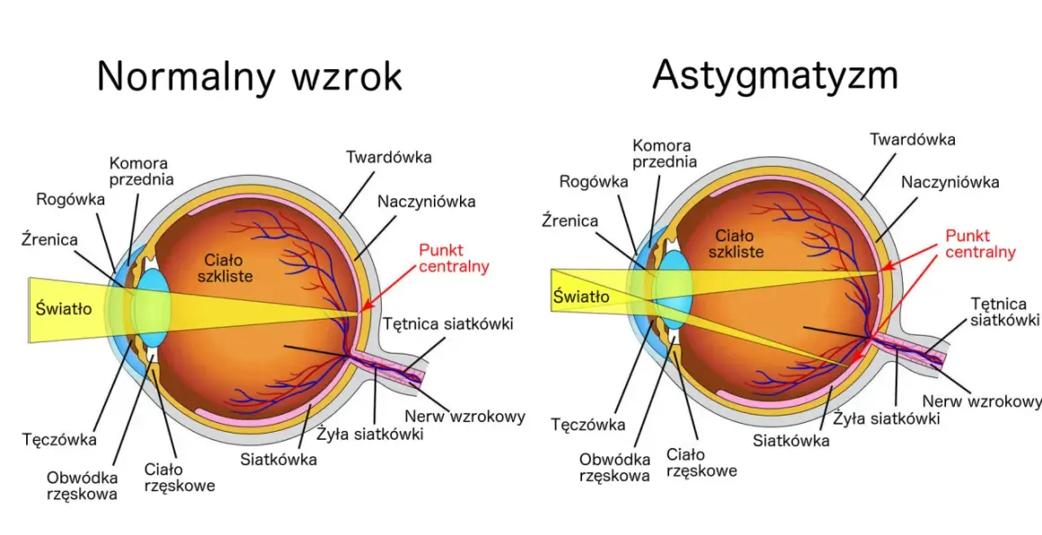 Porównanie budowy oka z normalnym wzrokiem i astygmatyzmem, gdzie wada wzroku plus i minus jednocześnie powoduje zniekształcenie obrazu.