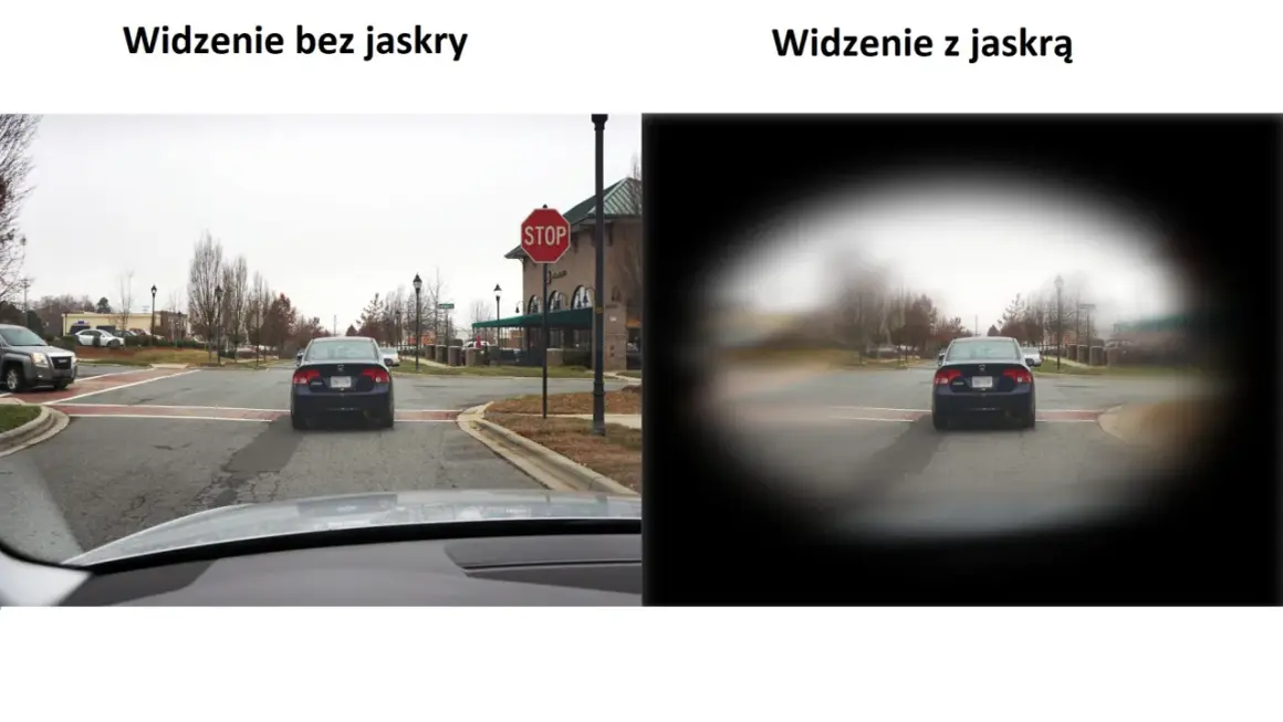 Widzenie z jaskrą to jak patrzenie przez tunel, gdzie obraz jest zamazany na obrzeżach, a centrum jest wyraźniejsze.