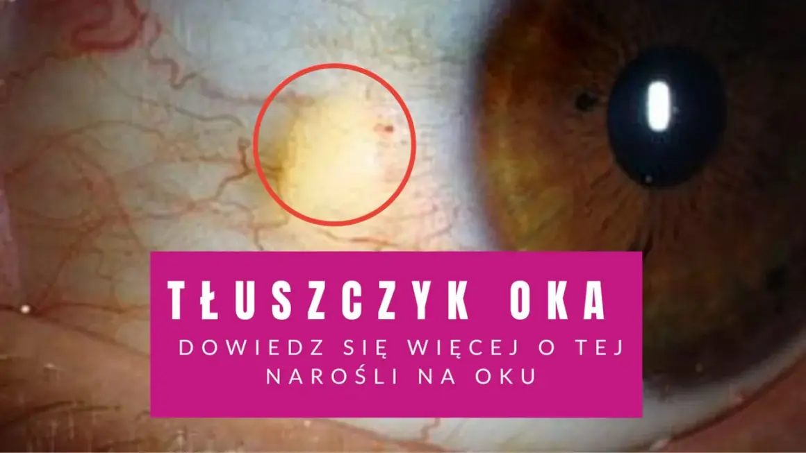 Żółta plamka na oku, czyli tłuszczyk, widoczna na białku. Dowiedz się więcej o tej narośli.
