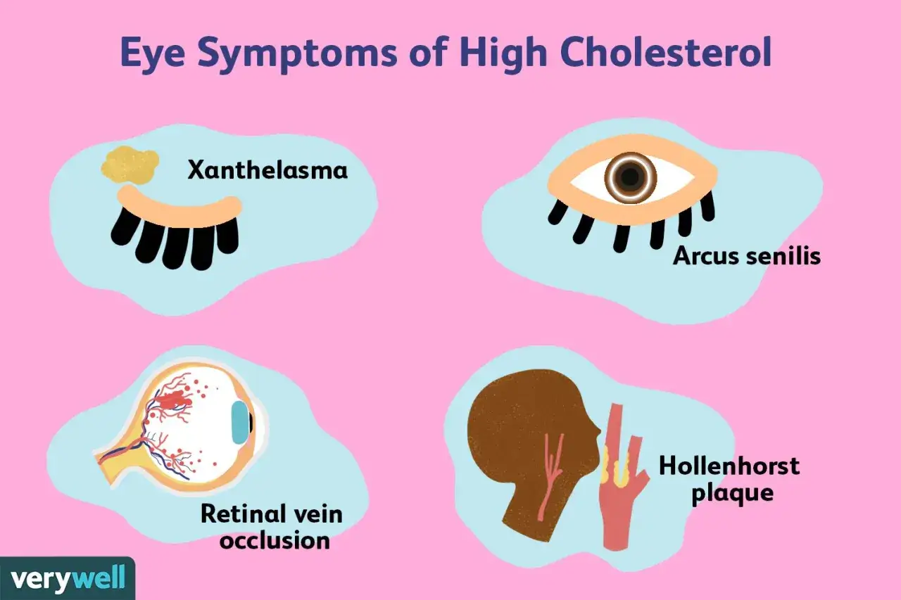 Objawy wysokiego cholesterolu w oczach: żółte plamy (Xanthelasma), pierścień na rogówce (Arcus senilis), zakrzepica żyły siatkówki i blaszki Hollenhorsta.