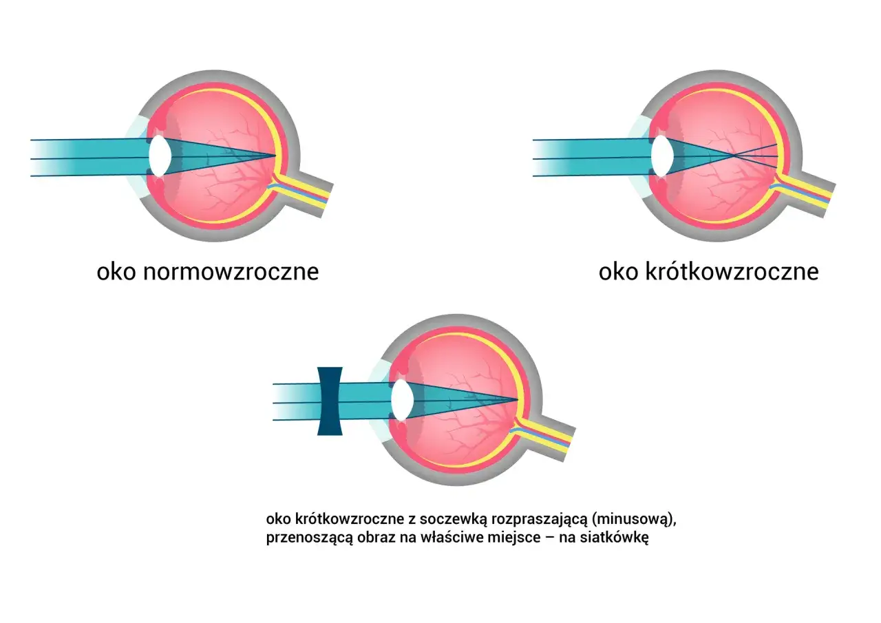 Schemat budowy soczewki oka: normowzroczne, krótkowzroczne i krótkowzroczne z soczewką rozpraszającą.