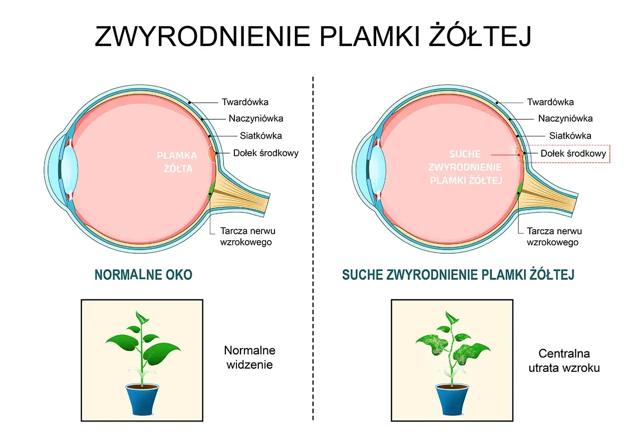 Porównanie zdrowego oka z uszkodzoną plamką żółtą, gdzie mroczek centralny powoduje utratę wzroku.
