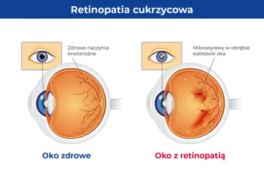 Retinopatia oka - objawy, badania i leczenie