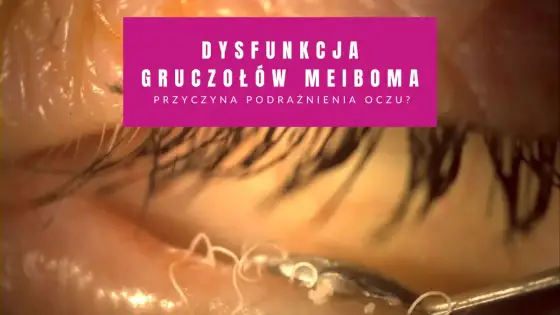 Zatkane gruczoły Meiboma - objawy i bezpieczne postępowanie