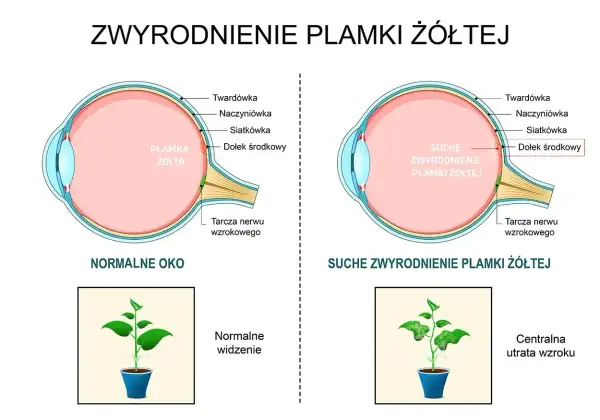 Porównanie normalnego oka z suchym zwyrodnieniem plamki żółtej. Pokazuje, jak szybko powiększa się otwór plamki żółtej, prowadząc do utraty wzroku.