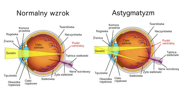 Porównanie budowy oka z normalnym wzrokiem i astygmatyzmem, gdzie wada wzroku plus i minus jednocześnie powoduje zniekształcenie obrazu.