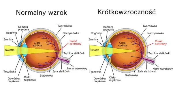 Porównanie budowy oka: normalny wzrok vs. wada wzroku - krótkowzroczność. Pokazano, jak światło skupia się na siatkówce.