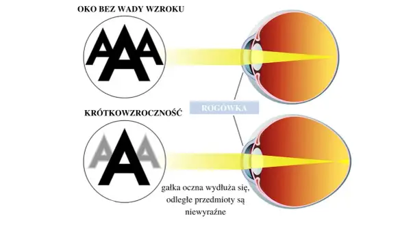 Ilustracja pokazuje przeliczanie wady wzroku na soczewki. Oko bez wady widzi ostro, krótkowzroczne oko widzi niewyraźnie.